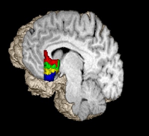 A map of the prefrontal cortex, with the subgenual prefrontal cortex highlighted in red. Original image from WTNL.com.