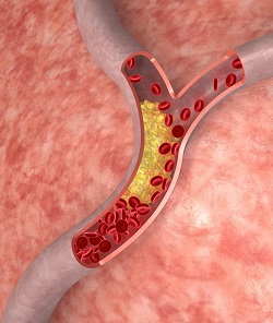 Diagram of cholesterol buildup in the artery and how it can contribute to high systolic blood pressure. Original illustration from the CDC.